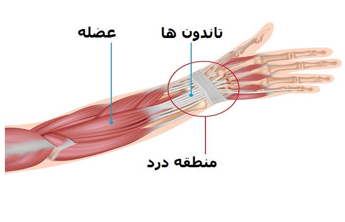 علت تاندونیت