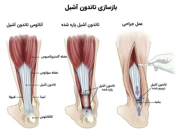 درمان تاندونیت