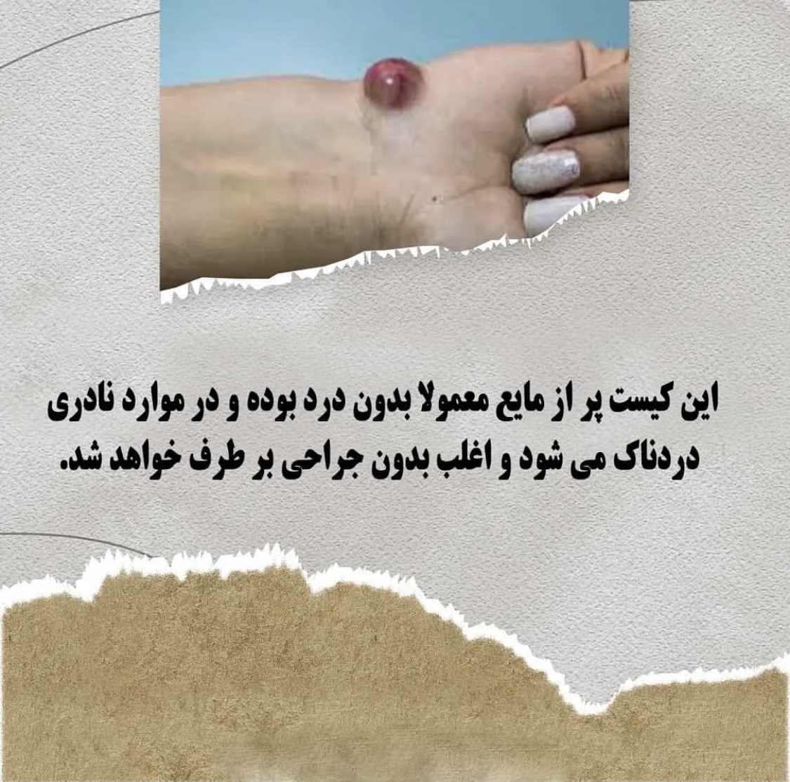 آیا کیست مچ دست خطرناک است؟