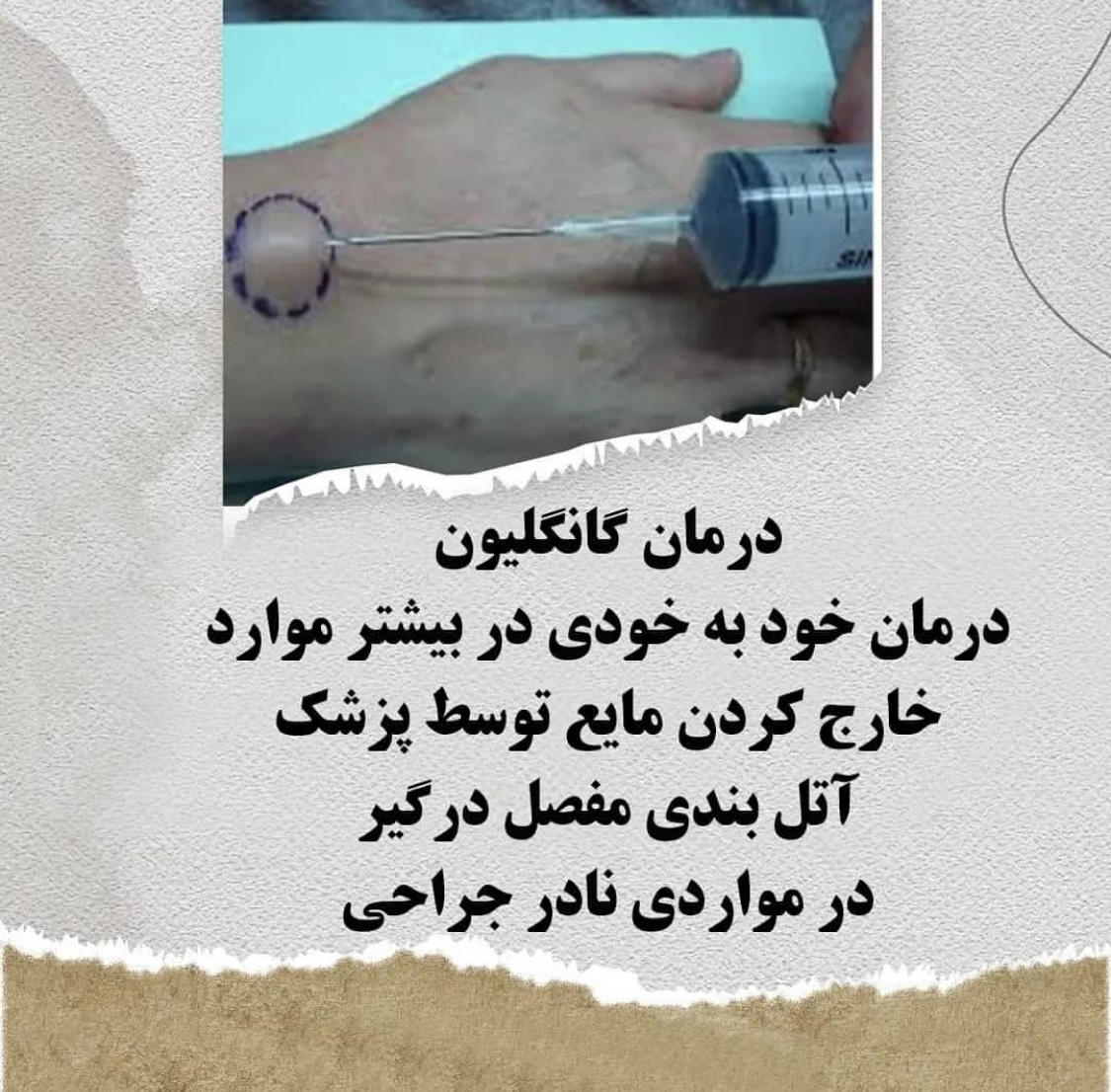 درمان کیست دست