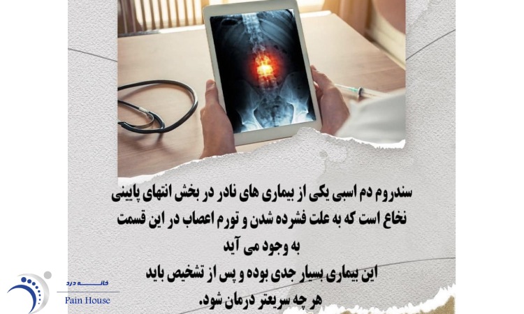 بیماری سندروم دم اسبی