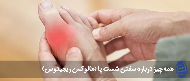 سفتی شست پا