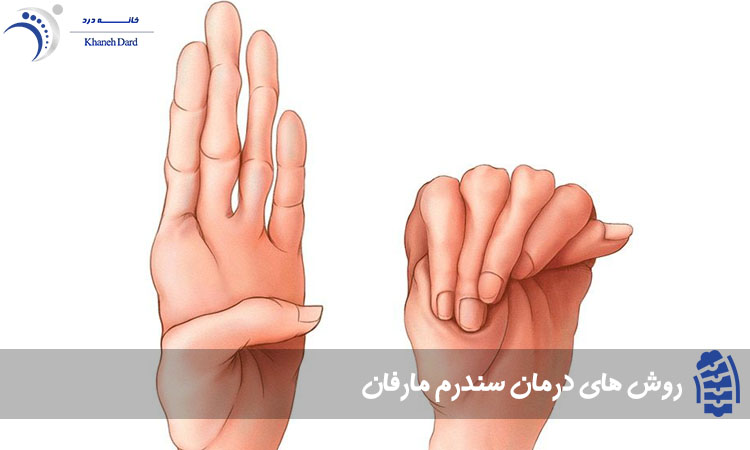 روش های درمان سندرم مارفان