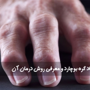 علت ایجاد گره بوچارد و معرفی روش درمان آن