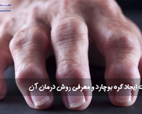 علت ایجاد گره بوچارد و معرفی روش درمان آن