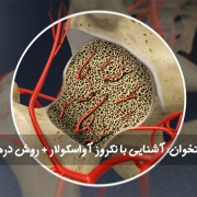 مرگ استخوان آشنایی با نکروز آواسکولار روش درمان