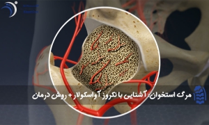 مرگ استخوان آشنایی با نکروز آواسکولار روش درمان