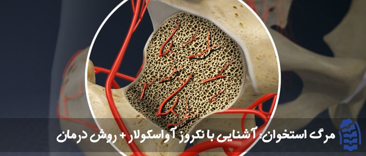مرگ استخوان آشنایی با نکروز آواسکولار روش درمان