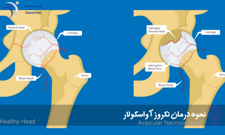 نحوه درمان نکروز آواسکولار