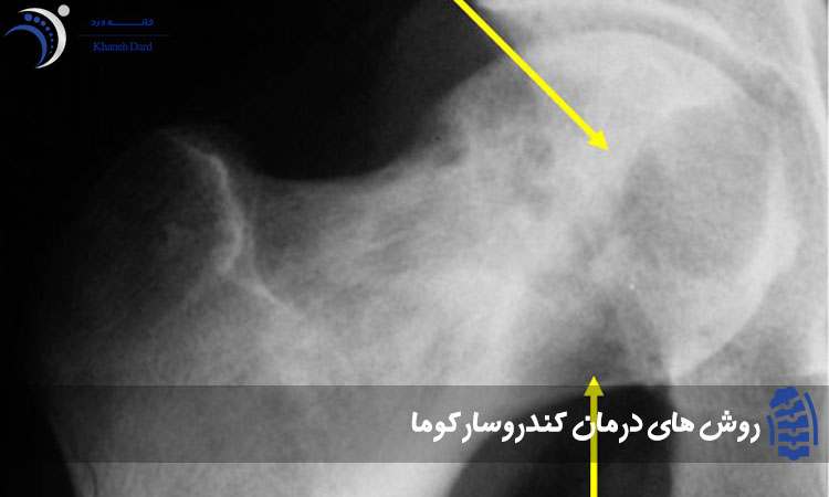 روش های درمان کندروسارکوما