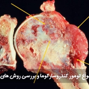 انواع تومور کندروسارکوما