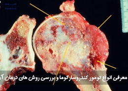 انواع تومور کندروسارکوما