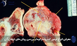 انواع تومور کندروسارکوما
