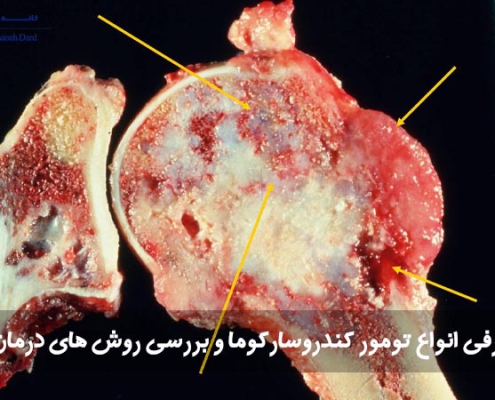 انواع تومور کندروسارکوما